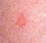 A typical triangular scalpel mar...